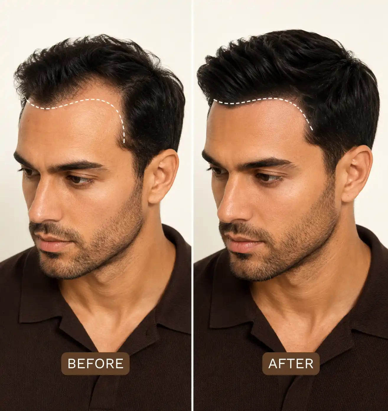 Men's Hair Loss: Understanding Causes and Finding Solutions