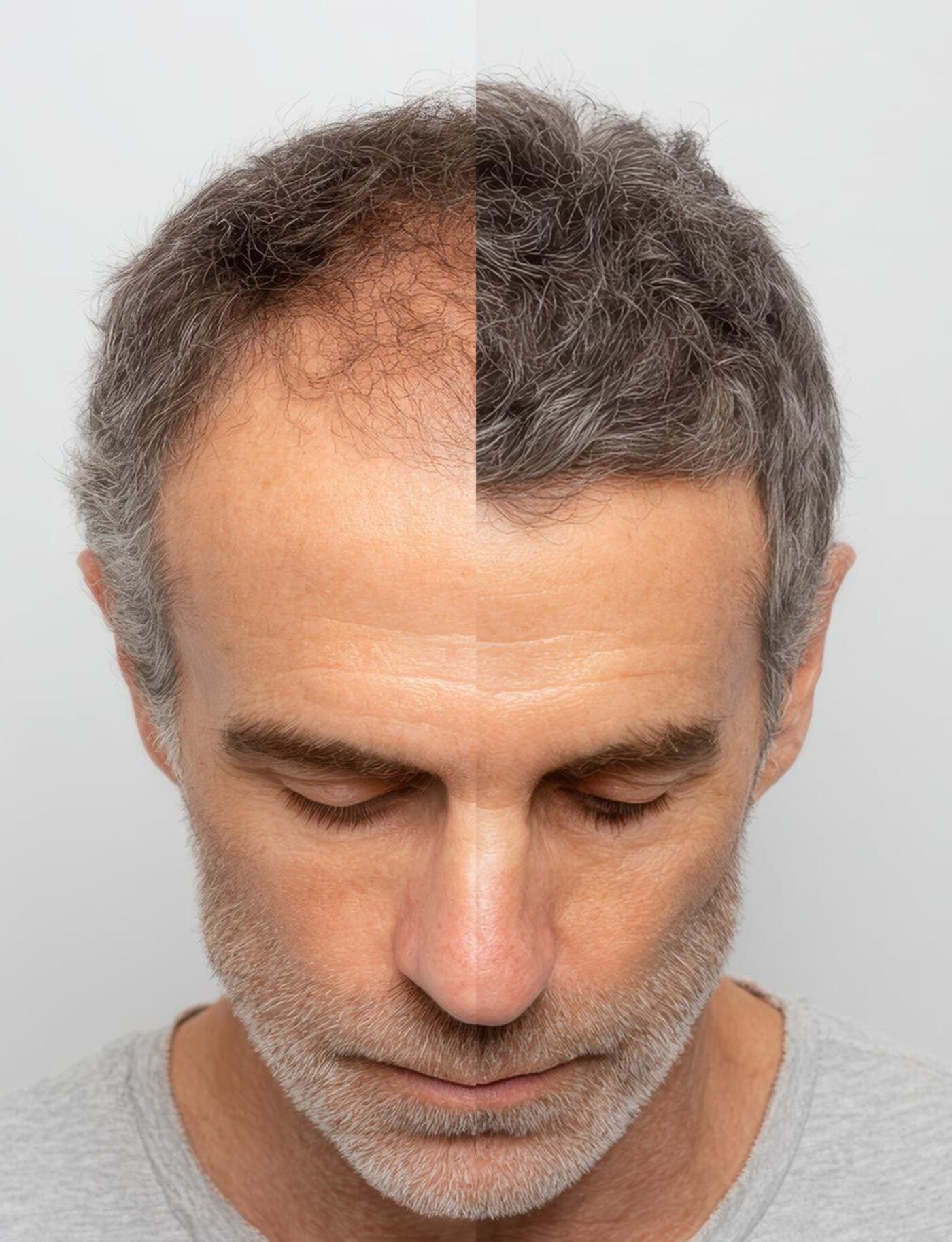 Before and after hair loss treatment